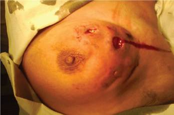 Tuberculosis de mama