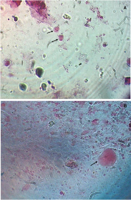 Dientamoeba fragilis  en coloraci&oacute;n
tricr&oacute;mica. Superior: Trofozoitos binucleados (superior: flechas). 400X.
Inferior: Trofozoito uninucleado (flecha). 1000X.