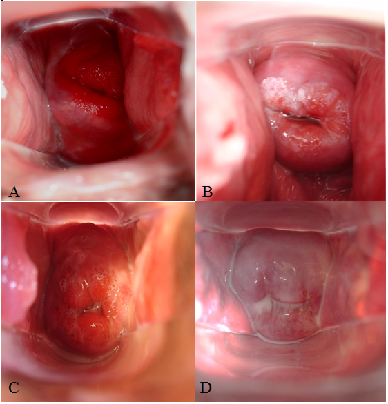 Especuloscopia de c&eacute;rvix. A. Exoc&eacute;rvix
eritematoso, presentando capa blanquecina en secci&oacute;n izquierda, pared vaginal y
cuello por Candida albicans. B.
C&eacute;rvix presentando grumos adherentes, y flujo en pared vaginal por Candida albicans y Candida krusei. C. Exoc&eacute;rvix con descarga de secreci&oacute;n blanco-amarillenta por Candida glabrata. D.
Secreci&oacute;n homog&eacute;nea blanca, de aspecto muy fluido causada por Candida tropicalis.