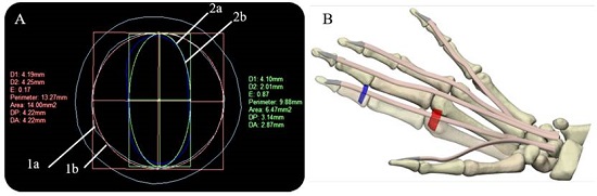 Cross-sectional areas of sheath and tendon, and final right-hand 3D model: (A) Overlapping of sheath and tendon cross-sectional areas (Index finger) (1a) Tendinous sheath shape (Cyan) (1b) calculation of the approximate area of the sheath (Red) (2a) tendon shape (Blue) (2b) calculation of the approximate area of the tendon (B) Final right-hand 3D model, flexor digitorum profundus tendons (skin), pulley A1 (red), and A3 pulley (blue)