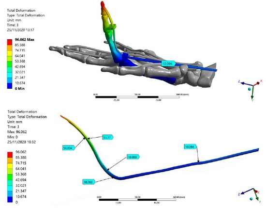 Total deformation of the Finite Element index finger model. FDP Tendon deformation regions are detailed; the maximum deformation is presented in the distal phalanx