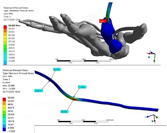 The Stress map of the Finite Element index finger model. FDP Tendon stress regions are detailed. The maximum principal stress of the model is presented in the FDP tendon-pulley A1 contact zone 
