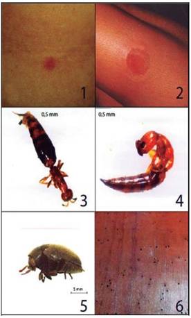 Lesi&oacute;n papuloeritematosa t&iacute;pica, Figura 2. Lesi&oacute;n urticariana con alg&uacute;n edema local, Figura 3 y 4. Sclerodermus sp. (Bethylidae) vista dorsal y lateral de una hembra, Figura 5. Escarabajo x&iacute;l&oacute;fago Calymmaderus pupatus (Ptinidae)vista lateral del adulto, Figura 6. Agujeros hechos por larvas del escarabajo en un mueble viejo