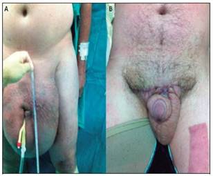 A) Linfedema escrotal gigante preoperatorio. Orientaci&oacute;n anterior, de 37 cm de dimensi&oacute;n vertical y 8cm de dimensi&oacute;n horizontal. B) Control postoperatorio 3 meses, con reducci&oacute;n del volumen escrotal