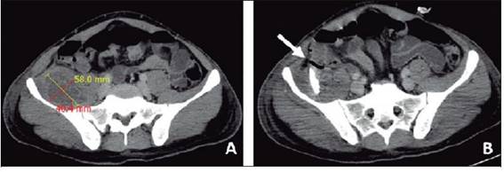 Tomograf&iacute;a axial computarizada de abdomen. Se observa colecci&oacute;n en m&uacute;sculo iliopsoas derecho (A). La flecha se&ntilde;ala el sitio de drenaje del absceso