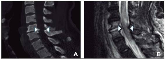 Tomograf&iacute;a computarizada muestra osteof&iacute;to (A) (puntas de flecha). La resonancia magn&eacute;tica corrobora compresi&oacute;n medular con edema (B) (puntas de flecha)