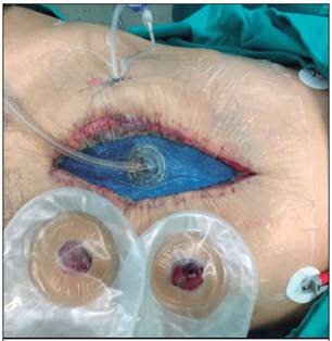 Terapia de abdomen abierto con presi&oacute;n negativa e instilaci&oacute;n. N&oacute;tese las dos f&iacute;stulas ent&eacute;ricas conducidas a piel en la porci&oacute;n inferior de la fotograf&iacute;a.