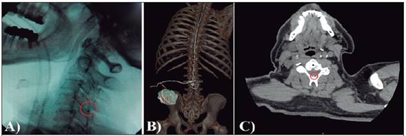 Estudios de imagen postoperatorios. A) Fluoroscopia durante el avance del cat&eacute;ter intratecal en el espacio cervical B) Reconstrucci&oacute;n 3D del sistema implantado C) Tomograf&iacute;a axial computarizada que muestra posici&oacute;n del cat&eacute;ter dorsal al cuerpo vertebral de C5.