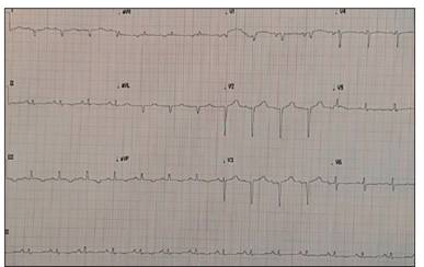 Electrocardiograma en reposo. Patr&oacute;n de pseudoinfarto en cara anteroseptal con microvoltaje.