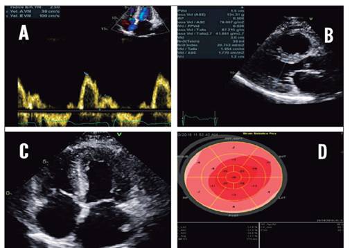 Ecocardiograma transtor&aacute;cico. A) Patr&oacute;n restrictivo en doppler tisular B) y C) Eje largo y vista cuatro c&aacute;maras apical, respectivamente. Infiltrado amiloide con remodelado severo conc&eacute;ntrico D) Strain 2D longitudinal deprimido en segmentos basales y medios
