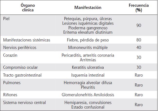 Manifestaciones cl&iacute;nicas frecuentes en vasculitis reumatoide