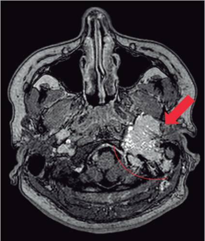 Resonancia magn&eacute;tica nuclear biomolecular realizada en octubre de 2013, donde se observa proceso infiltrativo tumoral a nivel de hueso temporal izquierdo, entre fosa craneal media y posterior sugestivo de paraganglioma (flecha roja).