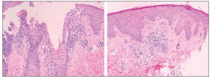 Biopsia de piel a nivel de espalda, donde se encuentra un infiltrado linfoc&iacute;tico con engrosamiento irregular de epidermis.