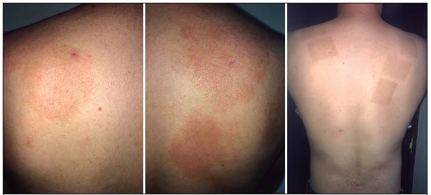 A y B previo a l&aacute;mpara exc&iacute;mero: lesiones con placas eritematosas ovaladas con p&aacute;pulas centrofoliculares. Figura C. Posterior a l&aacute;mpara, piel se evidencia sin lesiones; &uacute;nicamente se aprecia hiperpigmentaci&oacute;n postinflamatoria.