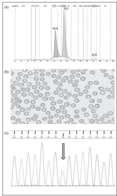 Hallazgos hematol&oacute;gicos de laboratorio en el propositus. (a) Electroforesis capilar de hemoglobina. Se identifica un pico de una variante de hemoglobina en la zona 11, con una concentraci&oacute;n de 37.2%, que coincide donde se ubica la Hb New York. (b) Morfolog&iacute;a de gl&oacute;bulos rojos, con hipocrom&iacute;a y anisocitosis leve dada por microcitos. (c) Electroferograma que muestra la variante de Hb New York, NM_000518.5(HBB):c.341T>A en heterocigosis.