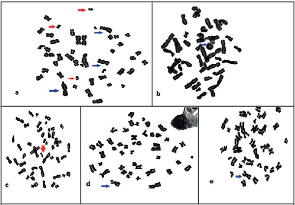 Cromosomopatías observadas en el análisis a los pacientes con cáncer que recibieron radioterapia (la flecha roja señala los ace; las otras cromosomopatías están señaladas con flechas azules): a) cromosomas dicéntricos, fragmentos acéntricos (ace) b) un cromosoma en anillo (r), c) un ace, d) una fractura cromatídica(chtb), e) una asociación satelítica (AS).