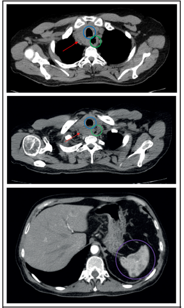 Tomografía computarizada sin contraste en un corte axial. 1 (A y B). Se evidencia una masa en el lóbulo tiroideo derecho (flecha roja) que ejerce efecto de masa sobre la tráquea (círculo azul) y el esófago (círculo verde), estenosando la luz de estas estructuras. 1C. Se evidencian múltiples lesiones hipodensas en el bazo sugestivas de metástasis esplénica (círculo morado). TC: Tomografía Computarizada