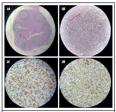 Imagen histopatológica de ganglio linfático. 2A. Se evidencia distorsión de la arquitectura normal del ganglio linfático, siendo imposible distinguir entre la corteza y la médula. Además, se observa la ausencia de folículos linfoides en la corteza (círculos verdes) 2B. Se muestra un infiltrado de centroblastos dispersos en todo el ganglio linfático más del 15 por campo de alta potencia, consistente con linfoma folicular de grado 3B de acuerdo con la clasificación de la Organización Mundial de la Salud (OMS). 2C y D. La inmunohistoquímica de la lesión reveló positividad para BCL-2 (2C) y un índice de proliferación Ki-67 de 60% (2D).