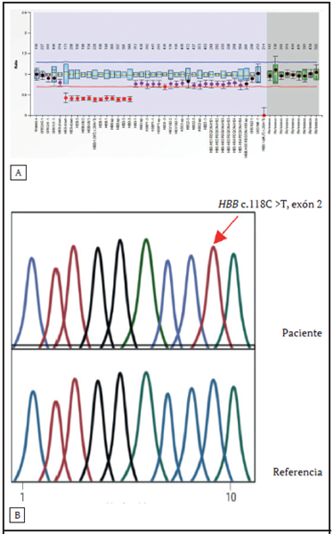 A. Representaci&oacute;n alelo 1: se detect&oacute; una deleci&oacute;n en la regi&oacute;n 11p15.4 de un tama&ntilde;o aproximado de 8,1 kb (12 sondas que se extienden desde el ex&oacute;n 3 del gen HBD hasta la regi&oacute;n corriente abajo del gen HBB, deleci&oacute;n reportada en la literatura como deltabeta 0 siciliana. B. Representaci&oacute;n alelo 2: se detect&oacute; la variante c.118C>T, p.(Gln40Ter) ubicada en el ex&oacute;n 2 y en estado hemicigoto. Esta variante produce un cod&oacute;n de terminaci&oacute;n prematuro y se asocia con B0 Talasemia.