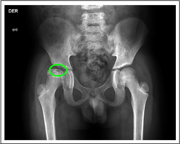 Radiograf�a AP de la cadera al diagn�stico.