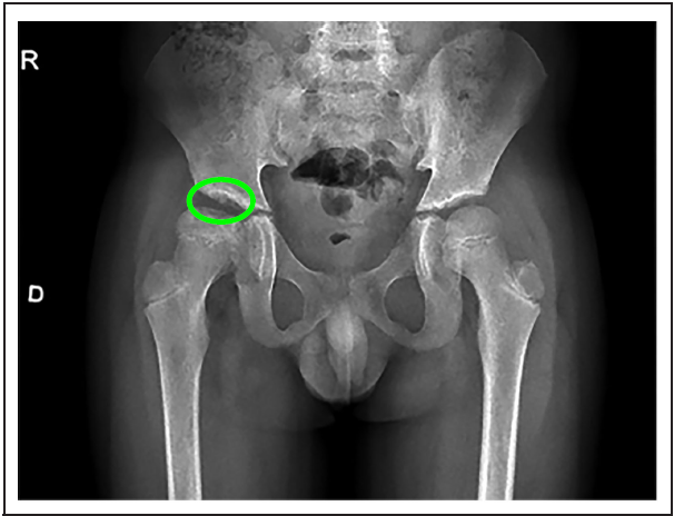 Radiograf�a AP de la cadera 5 meses posterior al diagn�stico, en etapa de remodelaci�n.
