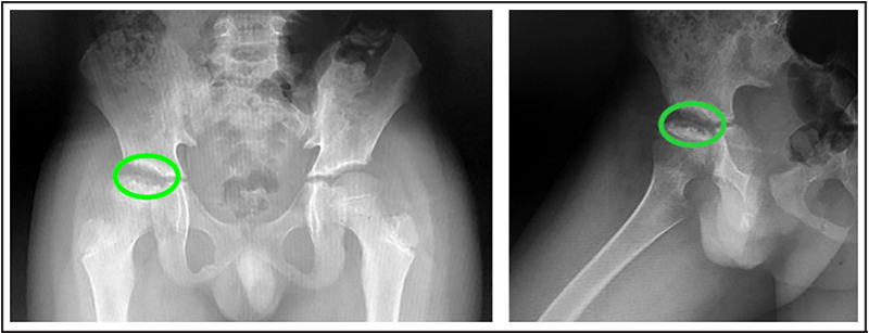 Radiograf�a AP y con rotaci�n externa de la cadera a�o y medio despu�s del diagn�stico.