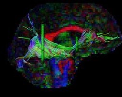 Diseccin mediante regiones de inters del fascculo fronto-occipital inferior derecho. Las regiones AND son mostradas en color verde y las regiones NOT en color rojo. Los tractos son capturados si atraviesan las regiones AND y no las regiones NOT. Para la coloracin de los cortes del espacio nativo y los tractos se utiliza la AF codificada por direccin. posible dividir el tracto en conjuntos de fibrillas de acuerdo a qu tan ‘cntricas’ o ‘perifricas’ sean. De aqu en adelante, a estos conjuntos de fibrillas que se obtienen como divisiones del tracto le llamamos ‘anillos radiales’. En el presente estudio, definimos cuatro anillos radiales y luego cinco segmentos longitudinales.
