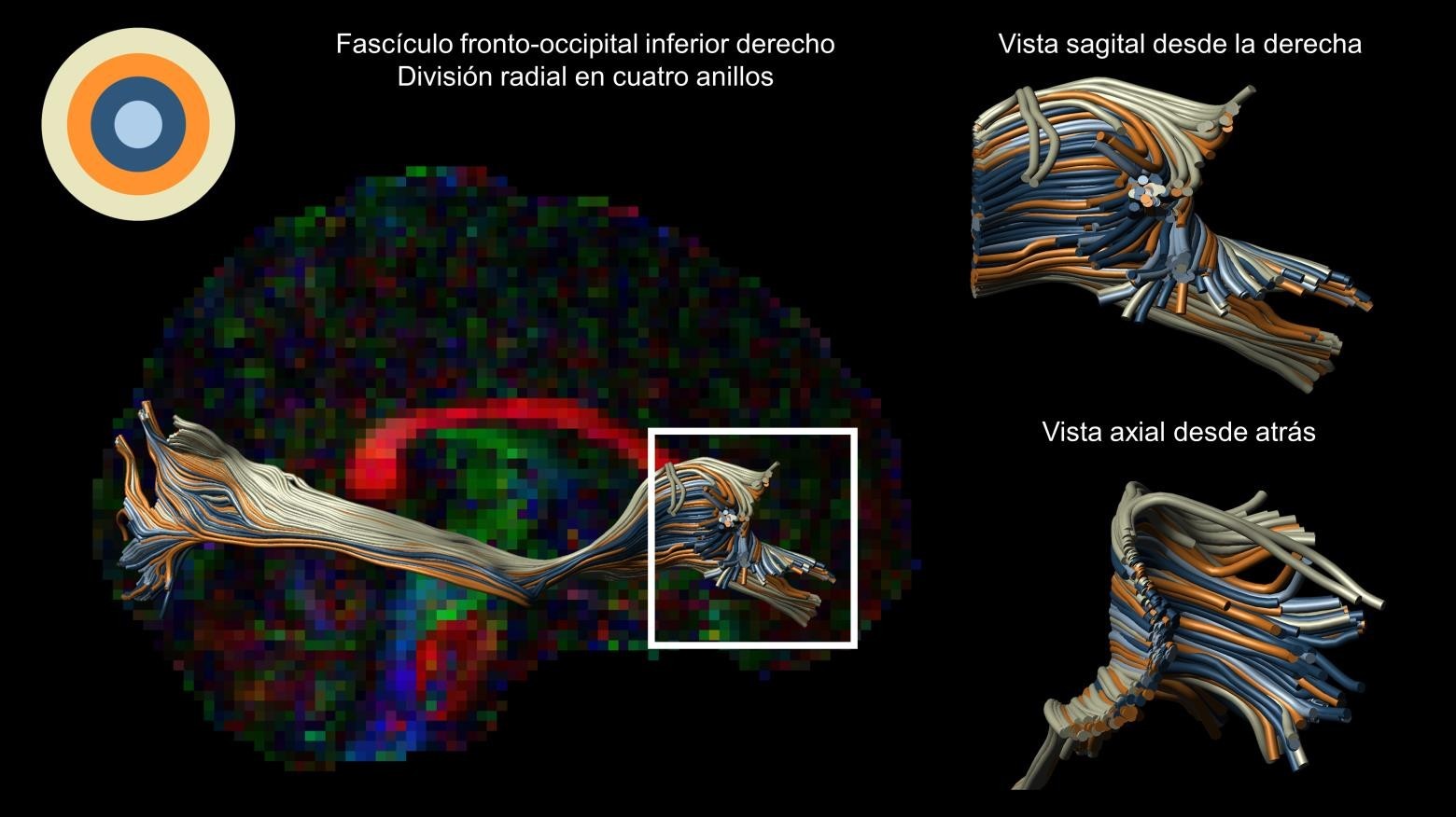 Ejemplo con un caso de la muestra de la divisin radial del fascculo fronto-occipital inferior derecho. A la derecha, se observa con mayor detalle la ubicacin de los anillos radiales
