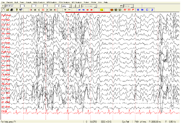 Fig. 1. Actividad
paroxística en Electro Digital de sueño de una menor de 5 años.