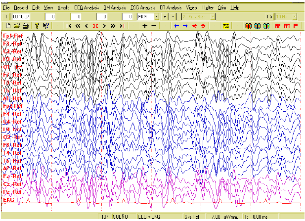 Fig. 2. Actividad paroxística en EEG Digital de sueño en un
menor varón de 11 años.