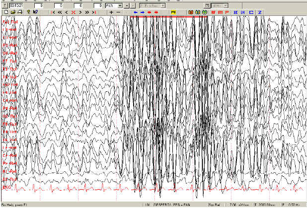 Fig. 3. EEG Digital en un menor de 5 años al momento de
despertar