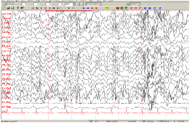 Fig. 4. EEG Digital de sueño en una menor de 9 años durante
foto estimulación, esta menor dentro de su sintomatología presentaba cuadros de Jaquecas.