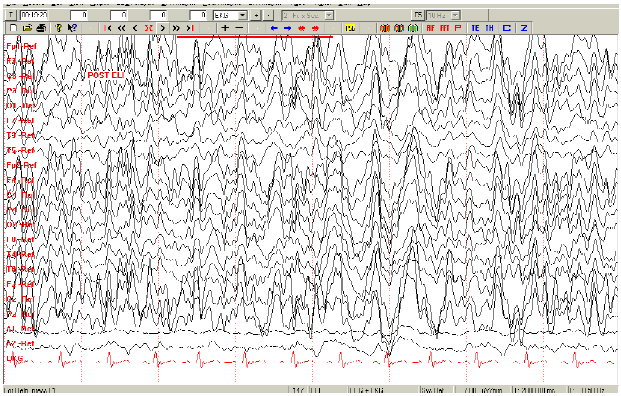 Fig. 5. EEG Digital de sueño de la misma menor (Fig.
4) posterior a la foto estimulación