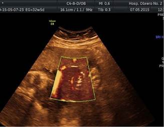 Pierna distal al anillo constrictor con vascularizacin presente, al estudio Power Doppler