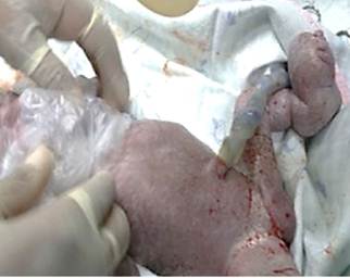 Recin nacido con anillo constrictor en la pierna con elefantiasis distal
