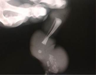 A la radiografa, se aprecia que adems del anillo constrictor en tejido blando, una muesca sea