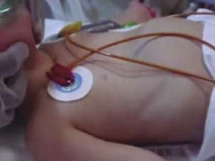 Tiraje intercostal, restracci&oacute;n esternal y disociaci&oacute;n toracoabdominal.