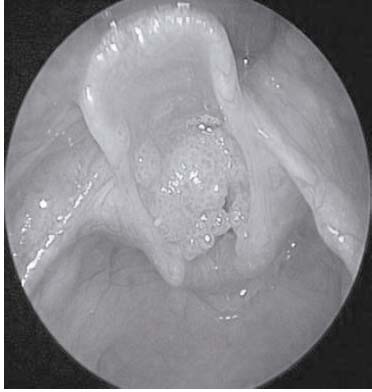 Papilomatosis Lar&iacute;ngea casi completamente obstructiva.