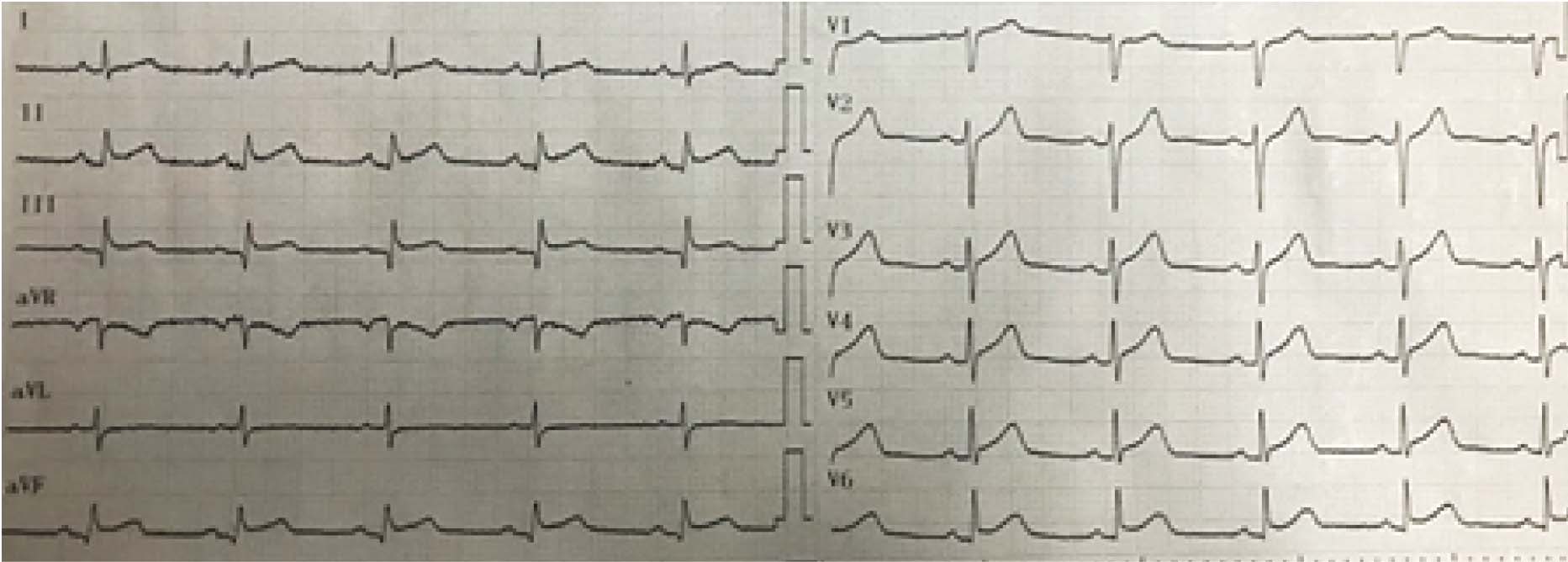 ECG muestra supradesnivel del segmento ST (SDST) en derivaciones inferiores con afectaci&oacute;n de cara lateral.