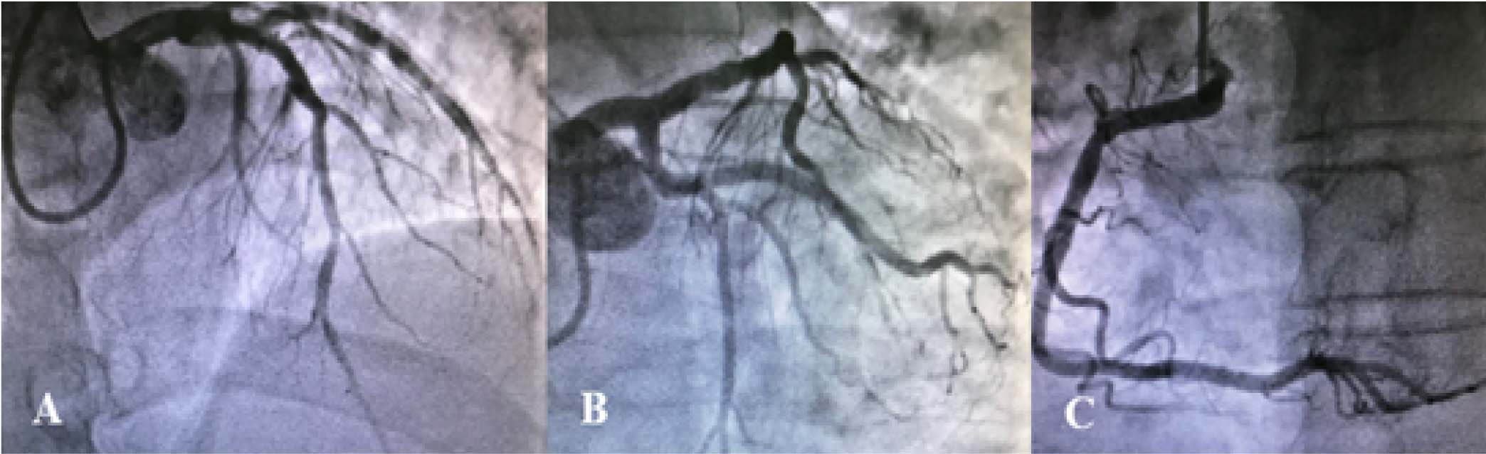 Coronariograf&iacute;a: Arteria descendente anterior (ADA) sin lesiones (A). Tronco (TCI) y arteria circunfleja sin lesiones (B). Arteria Coronaria derecha (ACD) sin lesiones (C).