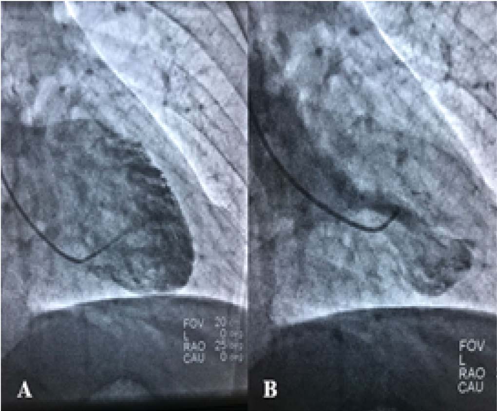 Ventriculograf&iacute;a del paciente en fase telediast&oacute;lica donde no se evidencia mayores alteraciones (A). Ventriculograf&iacute;a del paciente en fase sist&oacute;lica (derecha) donde se evidencia acinesia apical del ventr&iacute;culo, compensado con hipercinesia basal, otorgando la t&iacute;pica imagen del S&iacute;ndrome de Takotsubo: deformaci&oacute;n ampulosa por abombamiento sist&oacute;lico del segmento anterior y apical con hipercontractilidad de segmentos basales (Olla para capturar pulpos ?Takotsubo?) (B).