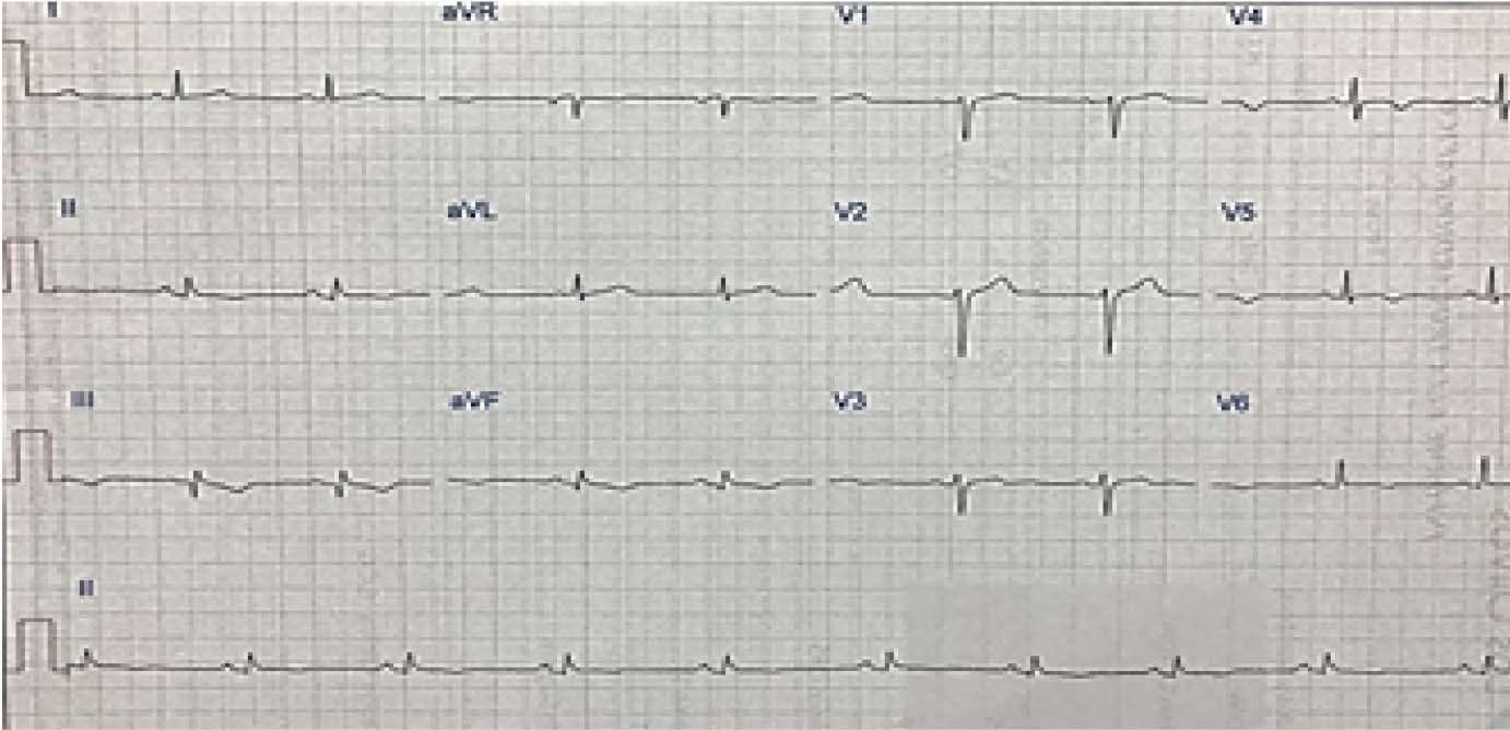 ECG de control muestra ondas T negativas en cara inferolateral.