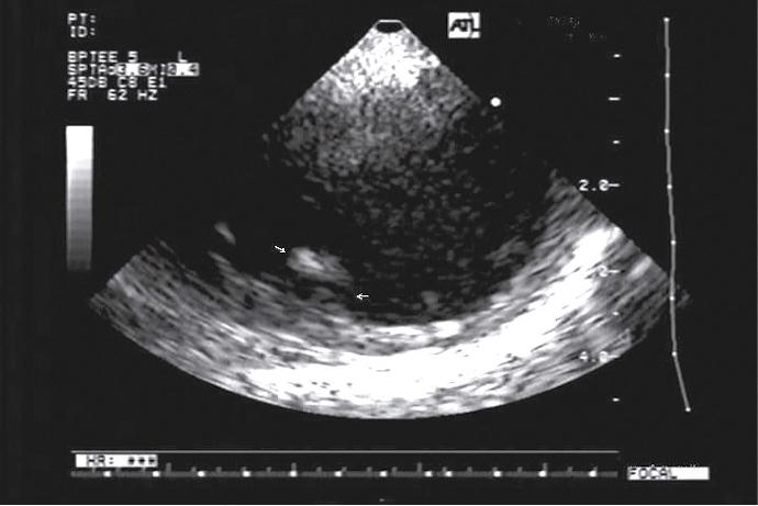 Ecocardiograma transesofágico donde se evidencia a nivel da le aorta ascendente una placa aterosclerótica complicada con trombo móvil compatible con debrís aórtico.