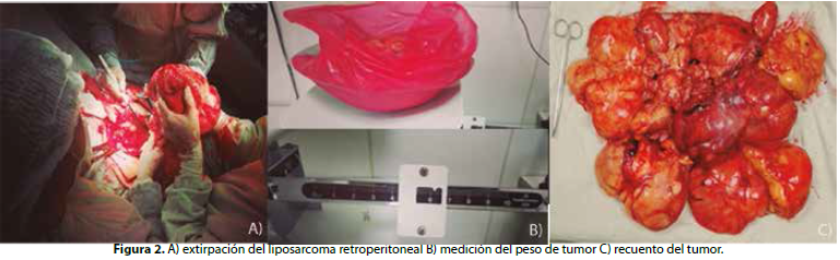 A) extirpación del liposarcoma retroperitoneal B) medición del peso de tumor C) recuento del tumor.