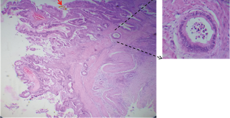 A. Moderately differentiated adenocarcinoma infiltrating to the muscle layer.
                B. Papillary formations towards the lumen.
              