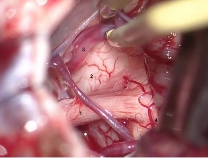 Visión quirúrgica microscópica. C)
