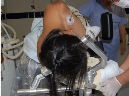 posicionamiento del paciente. La cabeza debe ser fijada con soporte de tres puntos (cabezal de Mayfield o Sugita).