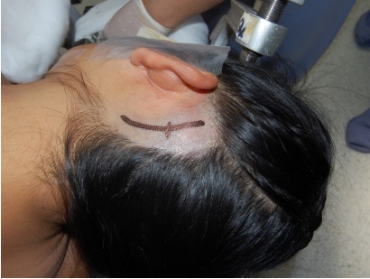 Marcación de la piel.