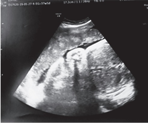 Placenta anterior, no previa. Grado I.