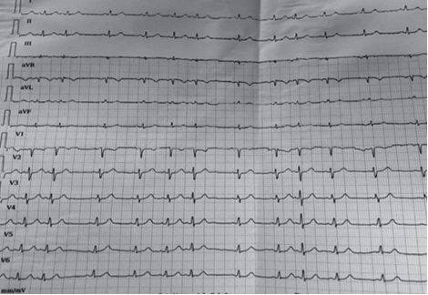 Electrocardiograma de la paciente.